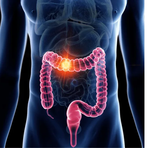 ¿Qué médico trata la diverticulitis?